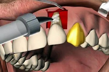 Behandlung von Zahnfleischrückgang - einer Rezessionsdeckung