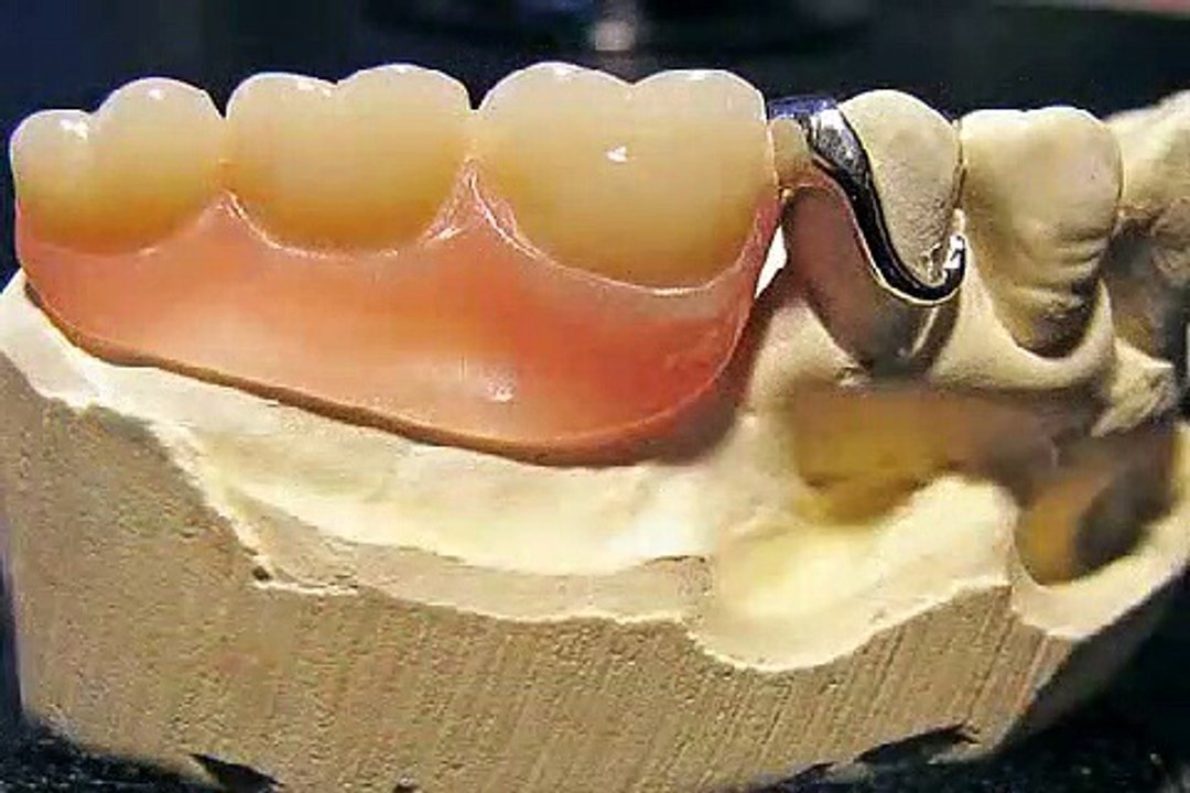 Eine Teilprothese mündet nach Jahren in die Vollprothese - wieso?