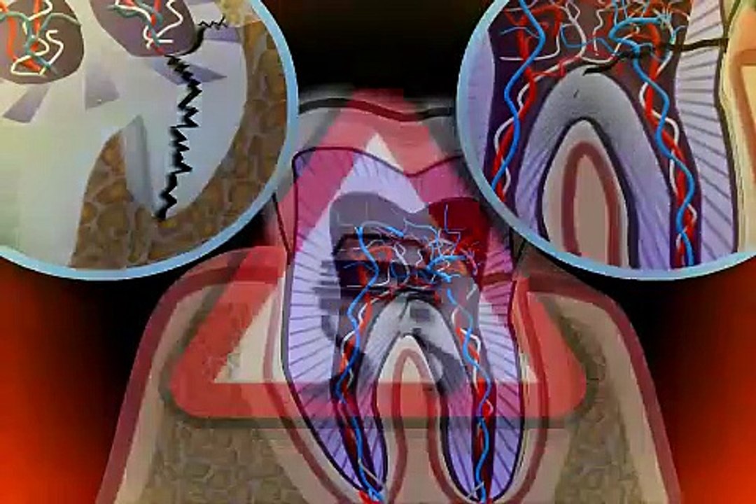 Zahn gebrochen - was tun?