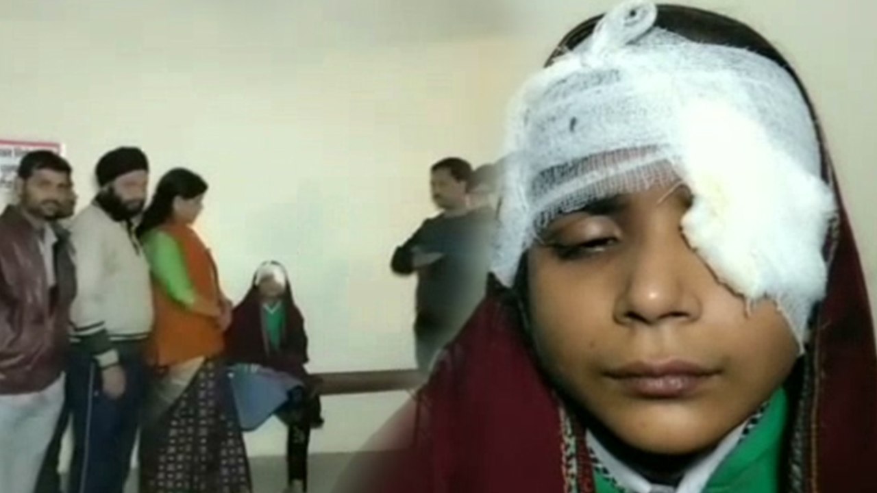 बेरहम शिक्षक ने डस्टर मारकर फोड़ी छात्रा की आंख, हॉस्पीटल में भर्ती कराकर सभी शिक्षक भाग निकले