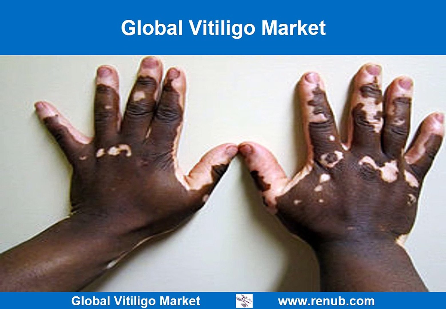 ⁣Global Vitiligo Market Future Outlook