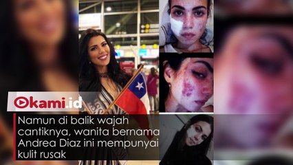 Di balik Makeup dan Wajah Cantiknya, Kontestan Miss Universe Ini Kulitnya Rusak