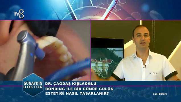 Ayrık dişler için çözüm bonding tedavisi