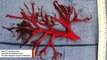 Doctors Stunned As Man Coughs Up A 6-Inch-Wide Blood Clot Shaped Like A Bronchial Tree