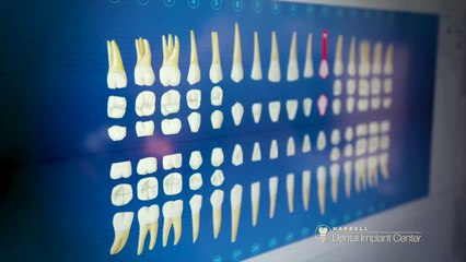 Dental implants and porcelain crowns give Maria a beautiful new smile