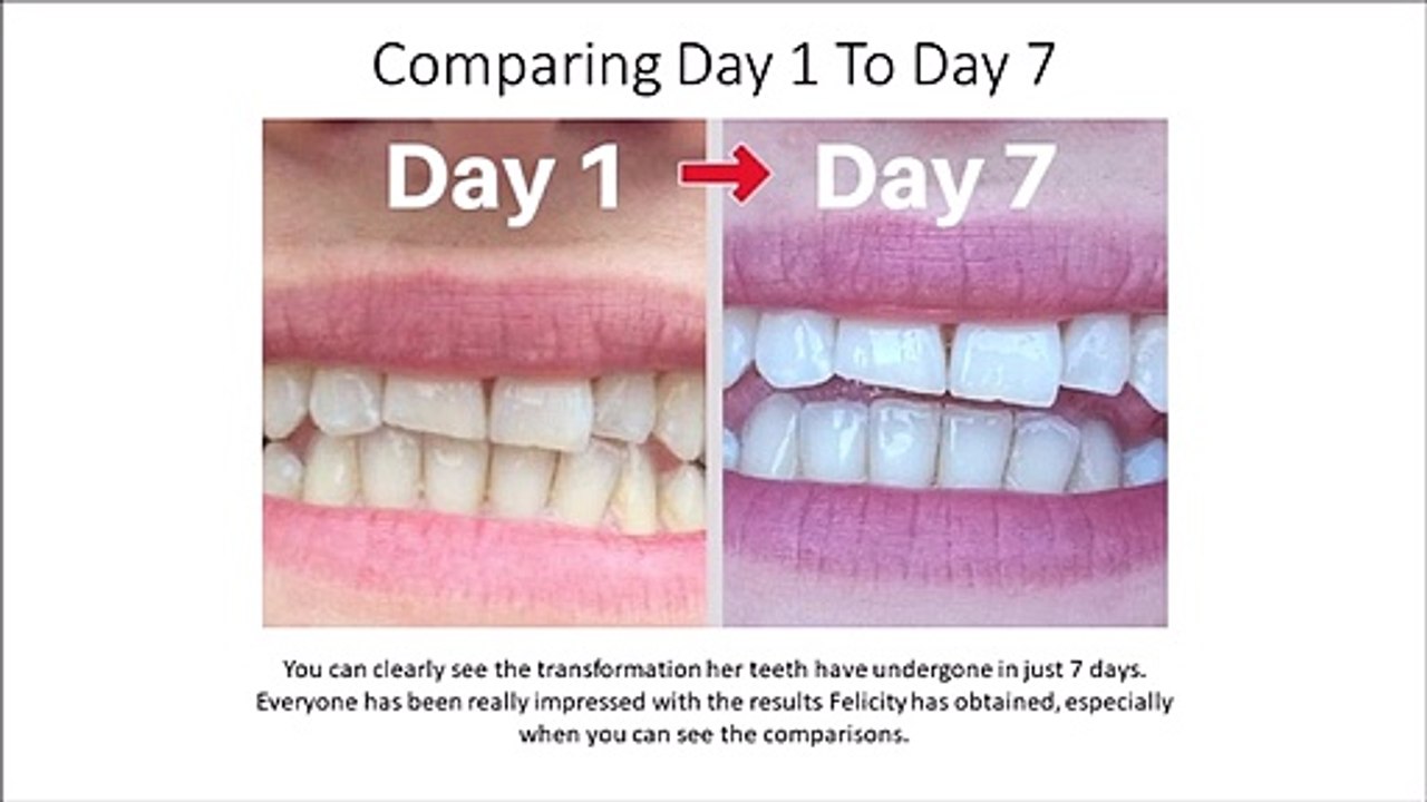 Proof The Billionaire teeth whitening Kit Works In Just 7 Days!