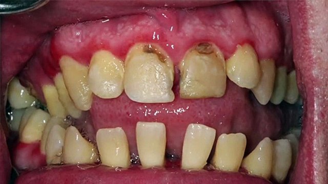 Voici à quoi ressemble les dents si on ne les brosse pas pendant 20 ans !