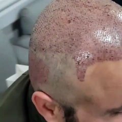 Canada Türkish Hair Transplant