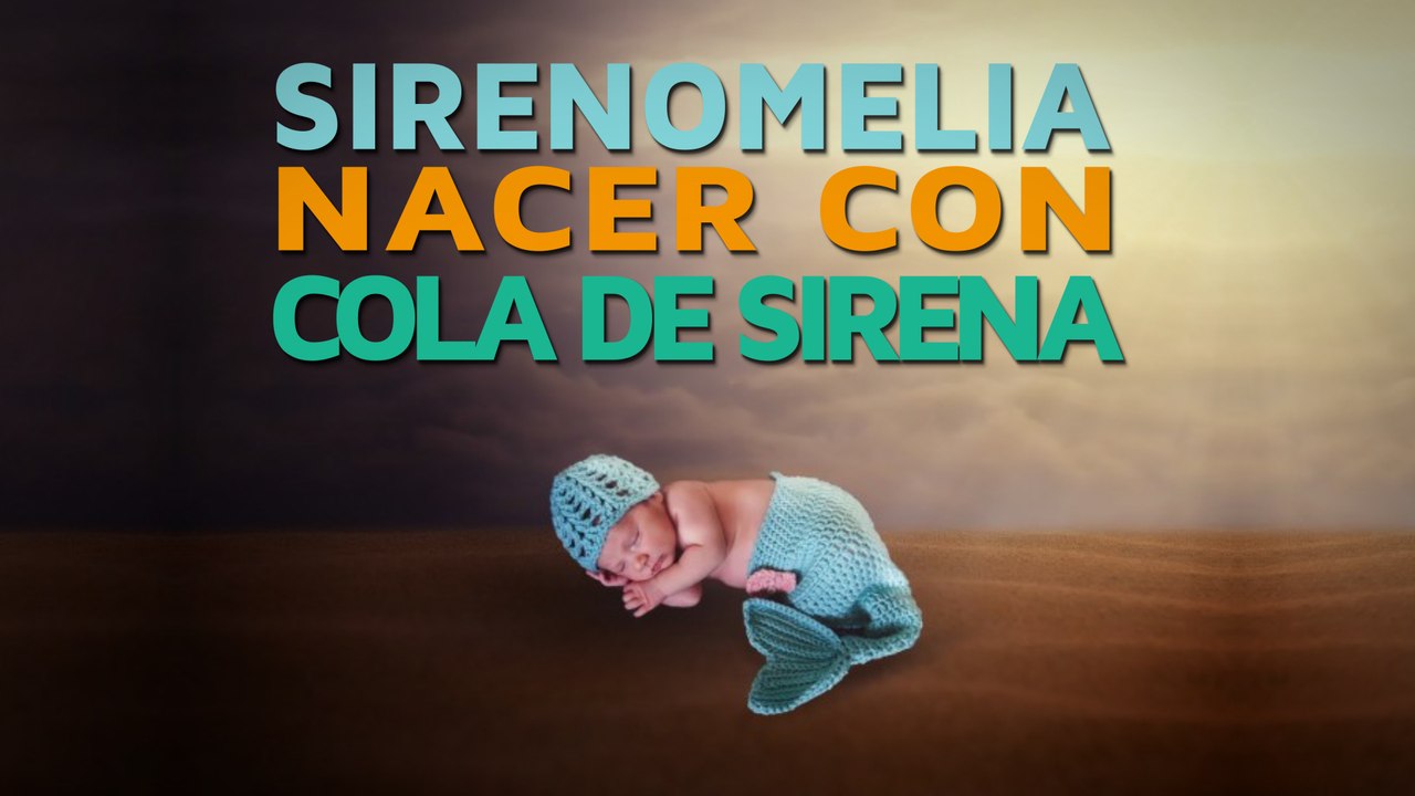 Sirenomelia | El síndrome de nacer con cola de sirena 