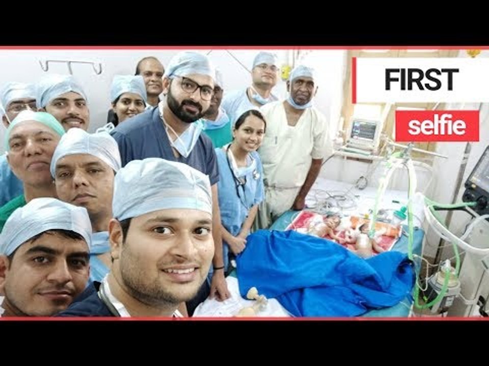 Surgeons Separated 3-day-old Conjoined Twins in a Painstaking Operation | SWNS TV