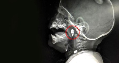 Boğazına Mandal Yayı Kaçan Bebek, Başarılı Operasyonla Kurtarıldı