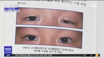 [스마트 리빙] '커튼눈 증후군' 방치하면 주름 생긴다 外
