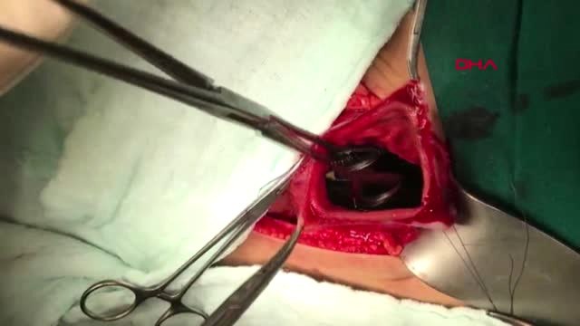 Şanlıurfa Otizmli Mehmet'in Midesinden Plastik Çay Kaşığı, Eldiven ve Kablo Çıktı-2