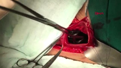 Şanlıurfa Otizmli Mehmet'in Midesinden Plastik Çay Kaşığı, Eldiven ve Kablo Çıktı-2