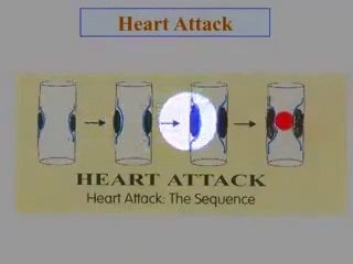 best Information about Heart Attack