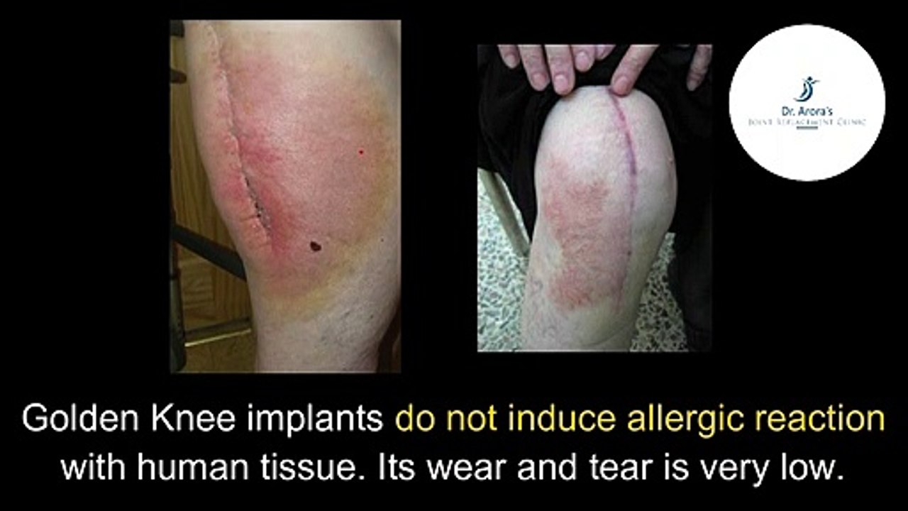 GOLDEN KNEE REPLACEMENT SURGERY