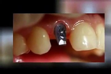 wie wird die Zahnkrone auf dem Implantat befestigt - Abutment