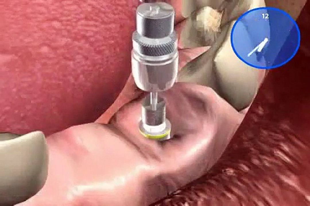 worauf es bei Zahnimplantaten ankommt