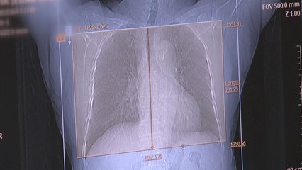 사망 1위 '폐암' 국가 암 검진에 포함...20·30세 우울증 검사 / YTN