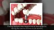 Should You Get Dental Implants, Find The Best Dentist in Arlington Heights