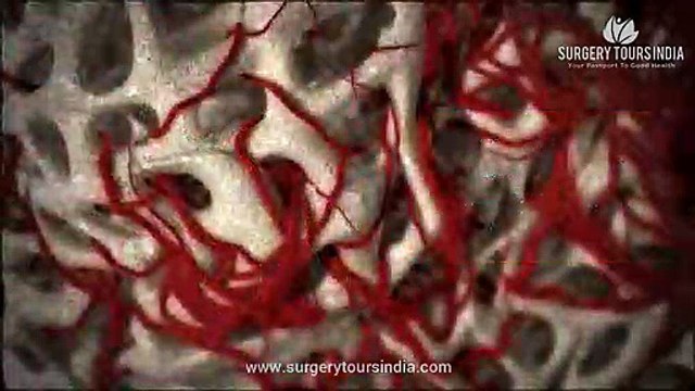 Blood Cancer Treatment in India | Best Hospitals for Blood Cancer Treatment India | Blood Cancer Information