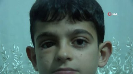 Suriyeli Mahmut Protez Gözüne Kavuştu