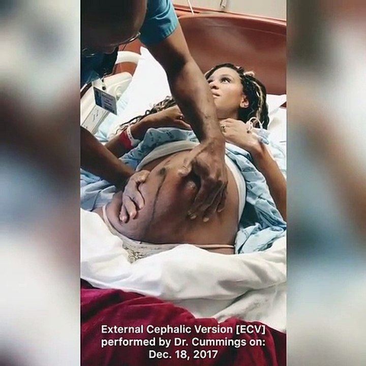 Un médecin remet un bébé dans le bon sens juste avant un accouchement