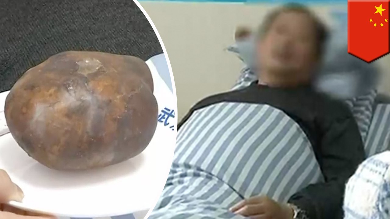 화장실도 안가고 밤새서 마작만 하던 남성, 거대한 방광결석 때문에 병원행