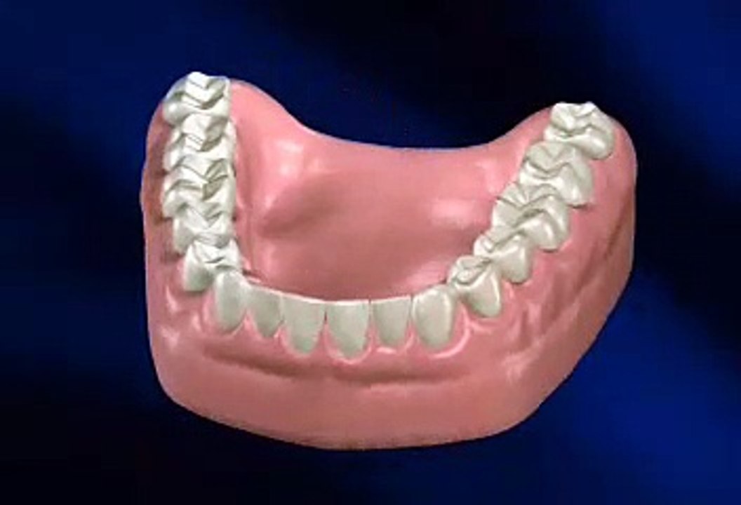 Gingivitis