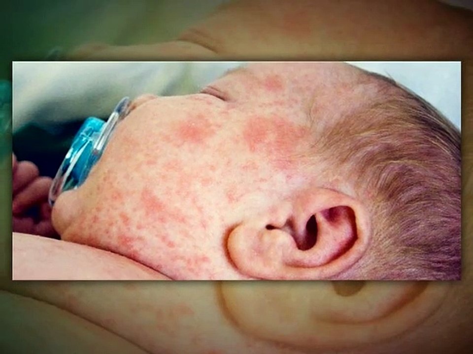 Watch: How Lactose intolerance causes indigestion | Cause, Symptoms, Diagnosis, Treatment