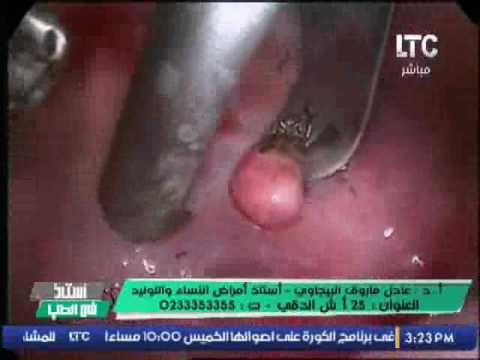 بالفيديو .. لأول مره د.عادل البيجاوى يعرض فيديو لــ استئصال اورام من داخل الرحم منظر صعب