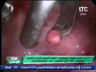 بالفيديو .. لأول مره  د.عادل البيجاوى يعرض فيديو لــ " استئصال اورام من داخل الرحم " منظر صعب