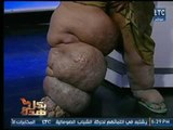 فيديو مُفزع : مواطن يسرد تفاصيل مرضه بـ داء الفيل عالهواء