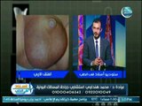 استشاري جراحة المسالك البولية يعرف الفتق الاربي واعراضه والأكثر عرضة للإصابة به