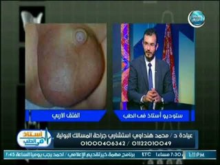 استشاري جراحة المسالك البولية يعرف الفتق الاربي واعراضه والأكثر عرضة للإصابة به