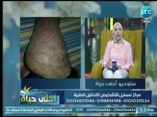 احلي حياة | مع ميار الببلاوي ود.محمد هاني حول علاج الام الظهر وتساقط الشعر بـ الباثولوجيا  21-7-2018
