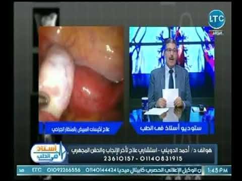استشاري علاج تأخر الإنجاب والحقن المجهري يوضح كيف يتم علاج تكيسات المبيض بلمنظار الجراحي