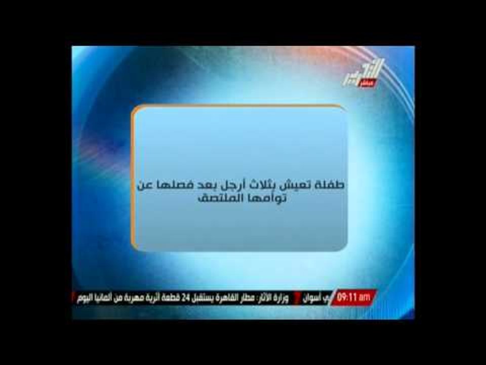 طفلة تعيش بثلاث أرجل بعد فصلها عن تؤأمها الملتصق