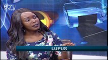 Symptoms & Presentation Of Lupus