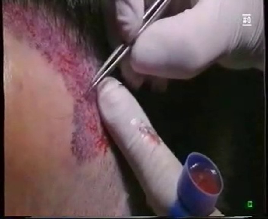 Cirugía de microinjerto de pelo:  Trasplante capilar
