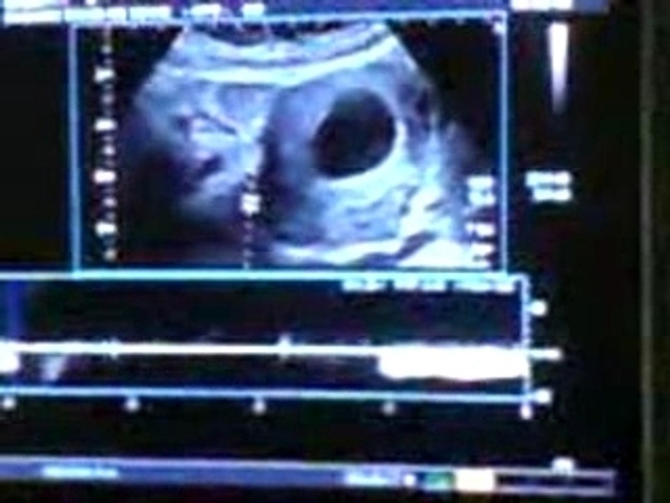 Echographie
