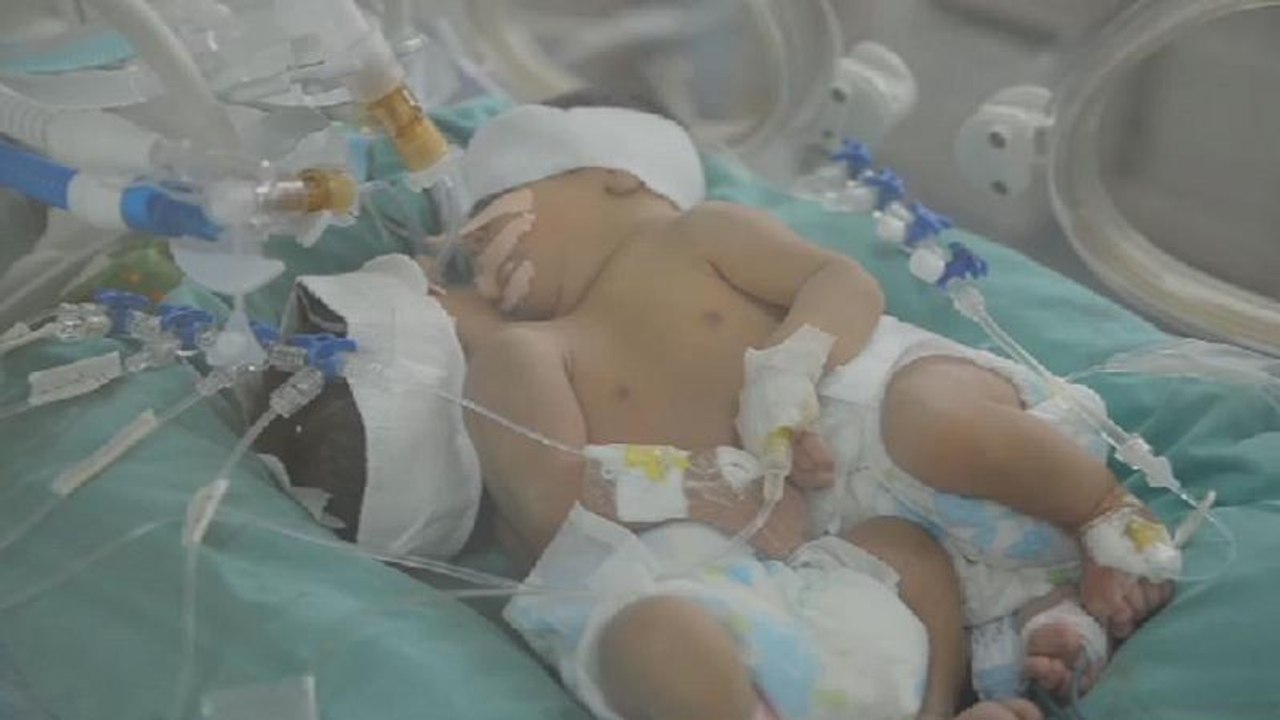 Naissance de siamoises à l'île Maurice