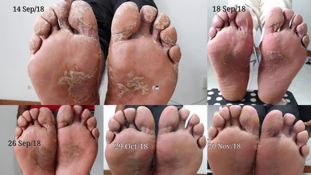 Como Quitar los Hongos de los Pies by Belleza sin Limites