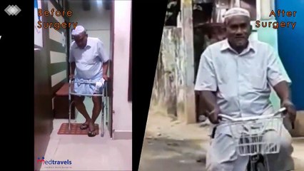 Knee Replacement Before and After Surgery