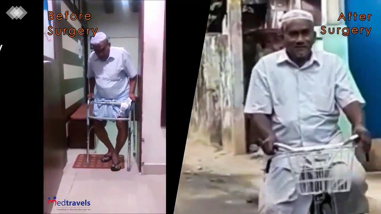 Knee Replacement Before and After Surgery