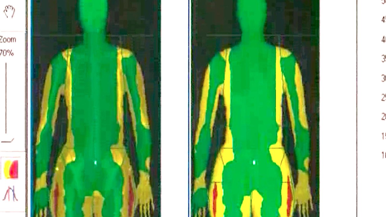iDXA Body Scan at Prolean Wellness