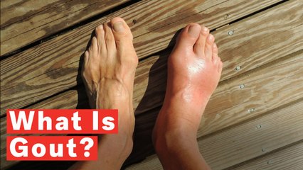 What Is Gout?