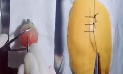 Cerrah, oğluna ameliyatı ‘meyvelerle’ böyle anlattı