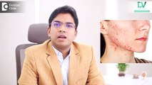 Dr. Sankeerth Vijayakumar - Common Tips for people having Acne or Pimples - Best Dermatologist In Bangalore