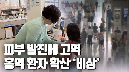 [자막뉴스] 홍역 확산…어린이 환자 급증, 20~30대도 취약